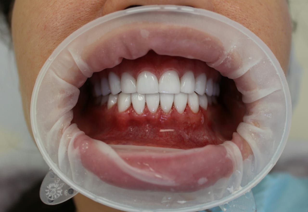 Плюси і мінуси вінірування зубів
