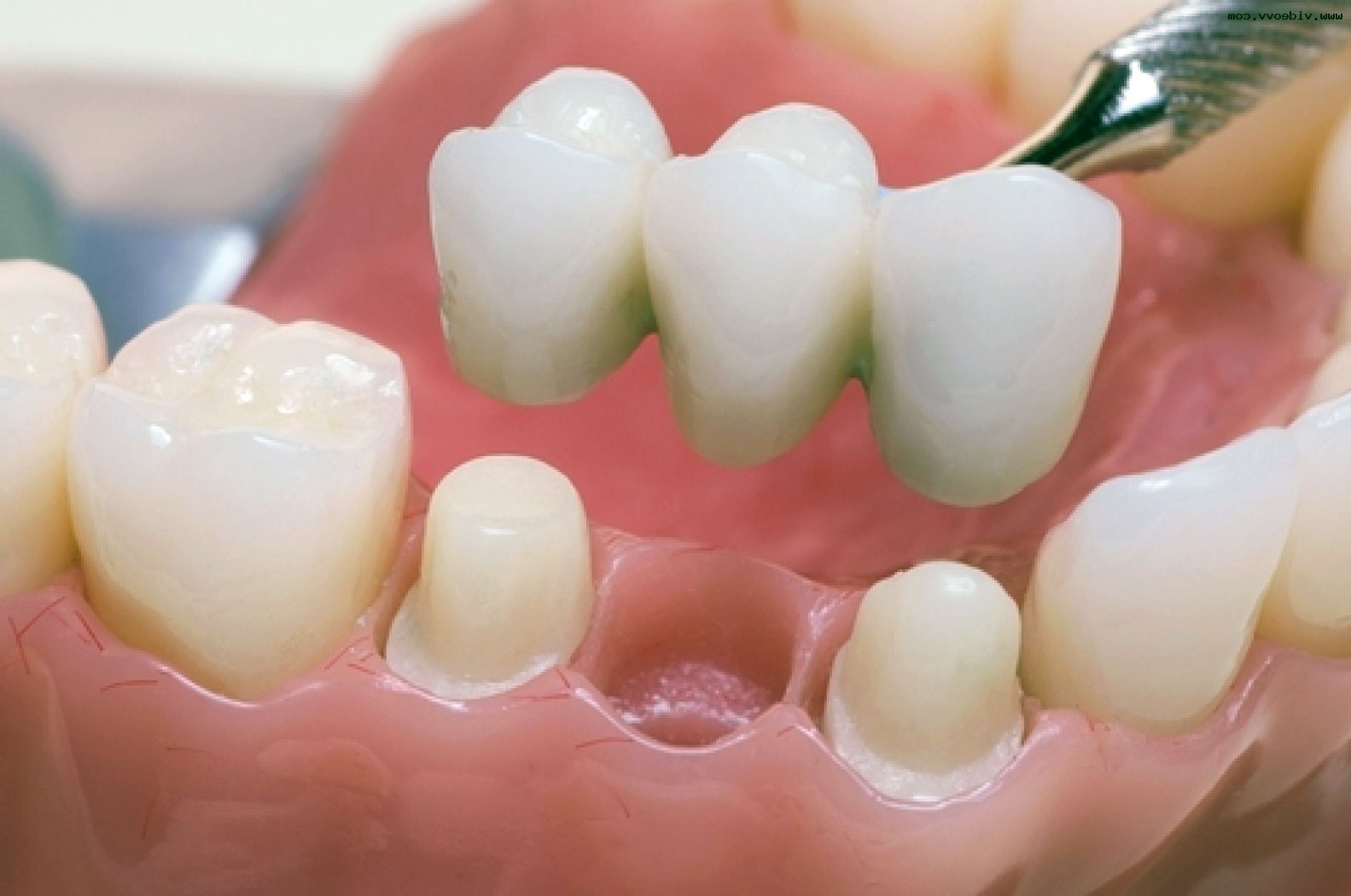 Що таке зубні протези