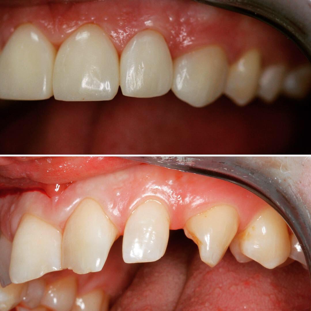 Як проводиться естетична реставрація зубів